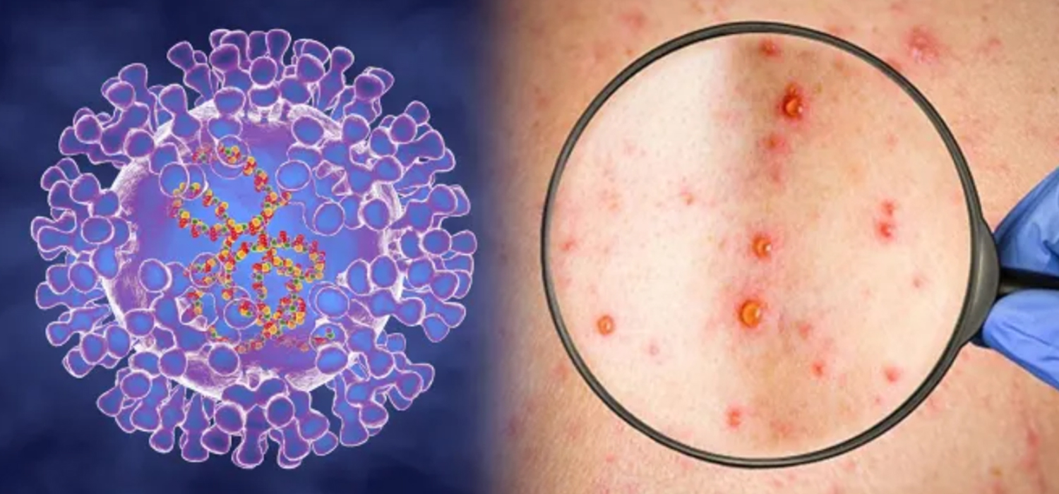 2022-6-6 monkeypox details